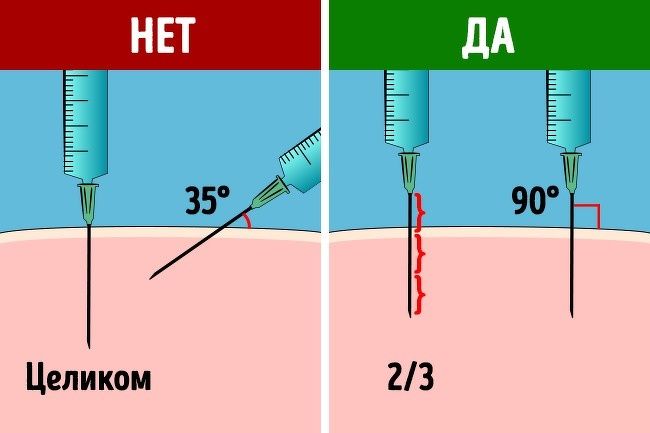 Как колоть уколы в ягодицу Как колоть уколы в ягодицу